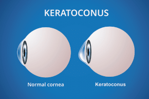 Keratoconus tedavileri, Cross-Linking, Cross-Linking Ameliyatı, Keratokonus tedavileri, Göz İçi Fakik ICL Lens ameliyatı, Katarakt Ameliyatı, Çapraz bağlama Ameliyatı