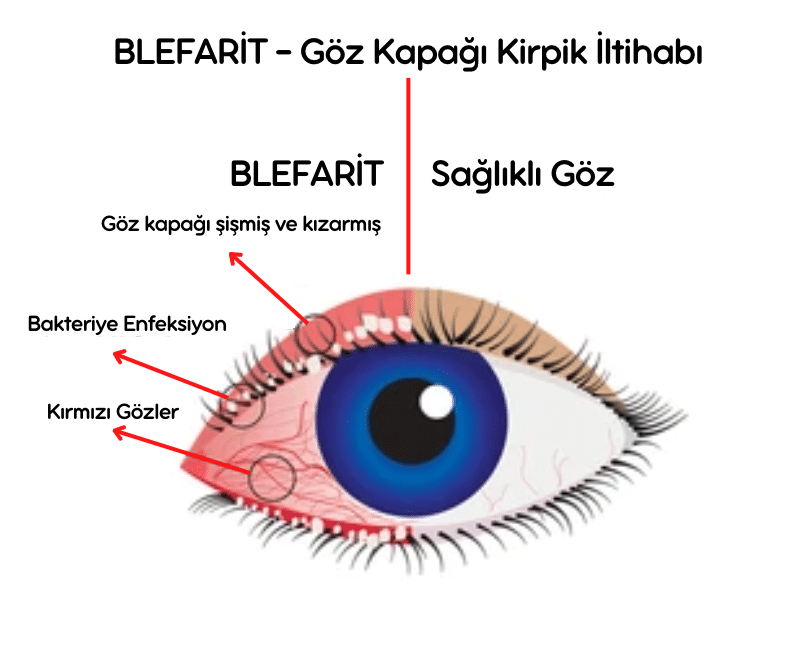 Blefarit, Göz Kapağı Kirpik İltihabı Hastalığı, Kirpik İltihabı Hastalığı, Kirpik İltihabı, blepharitis