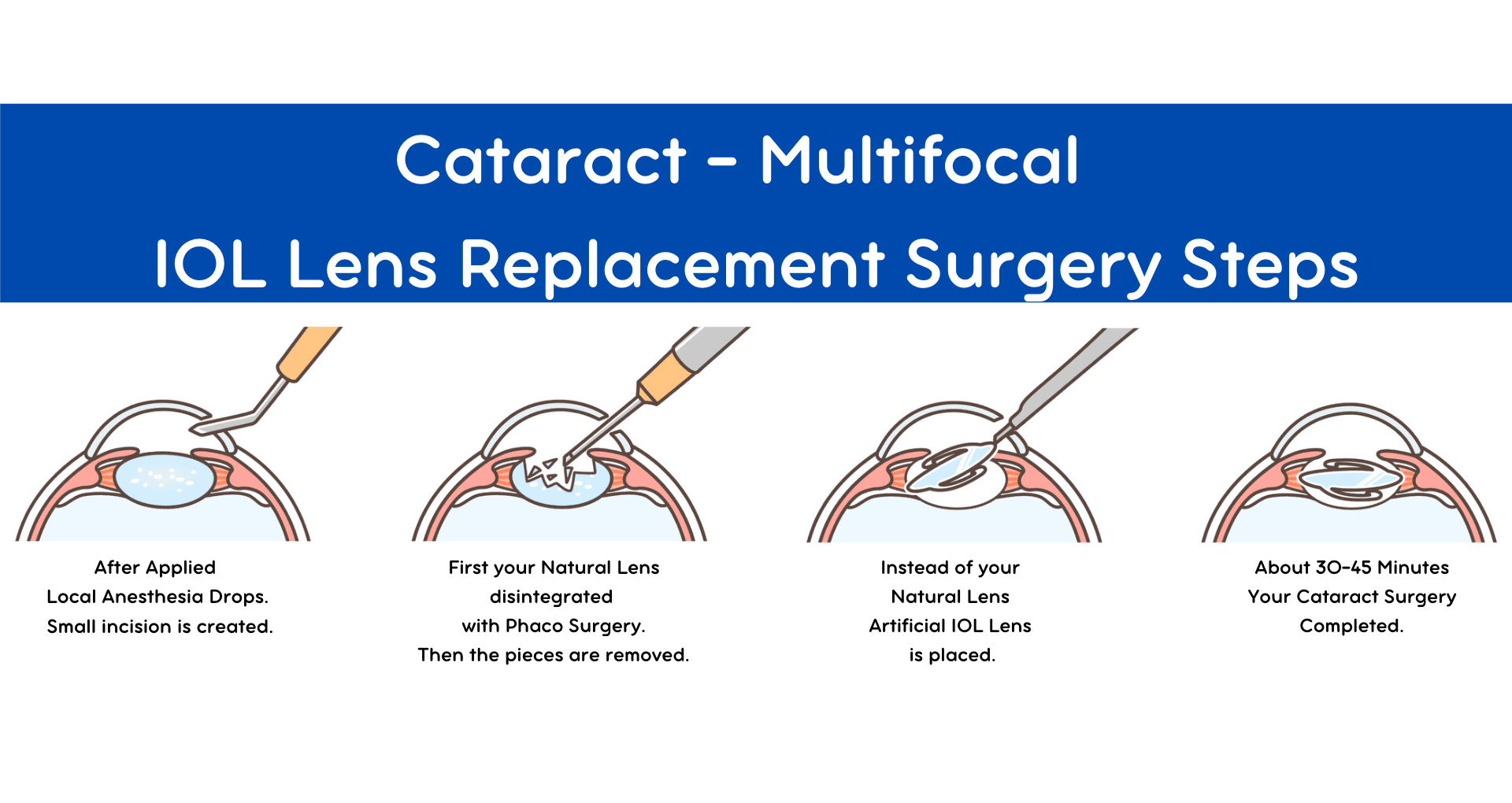 cataract surgery, monofocal, multifocal, trifocal