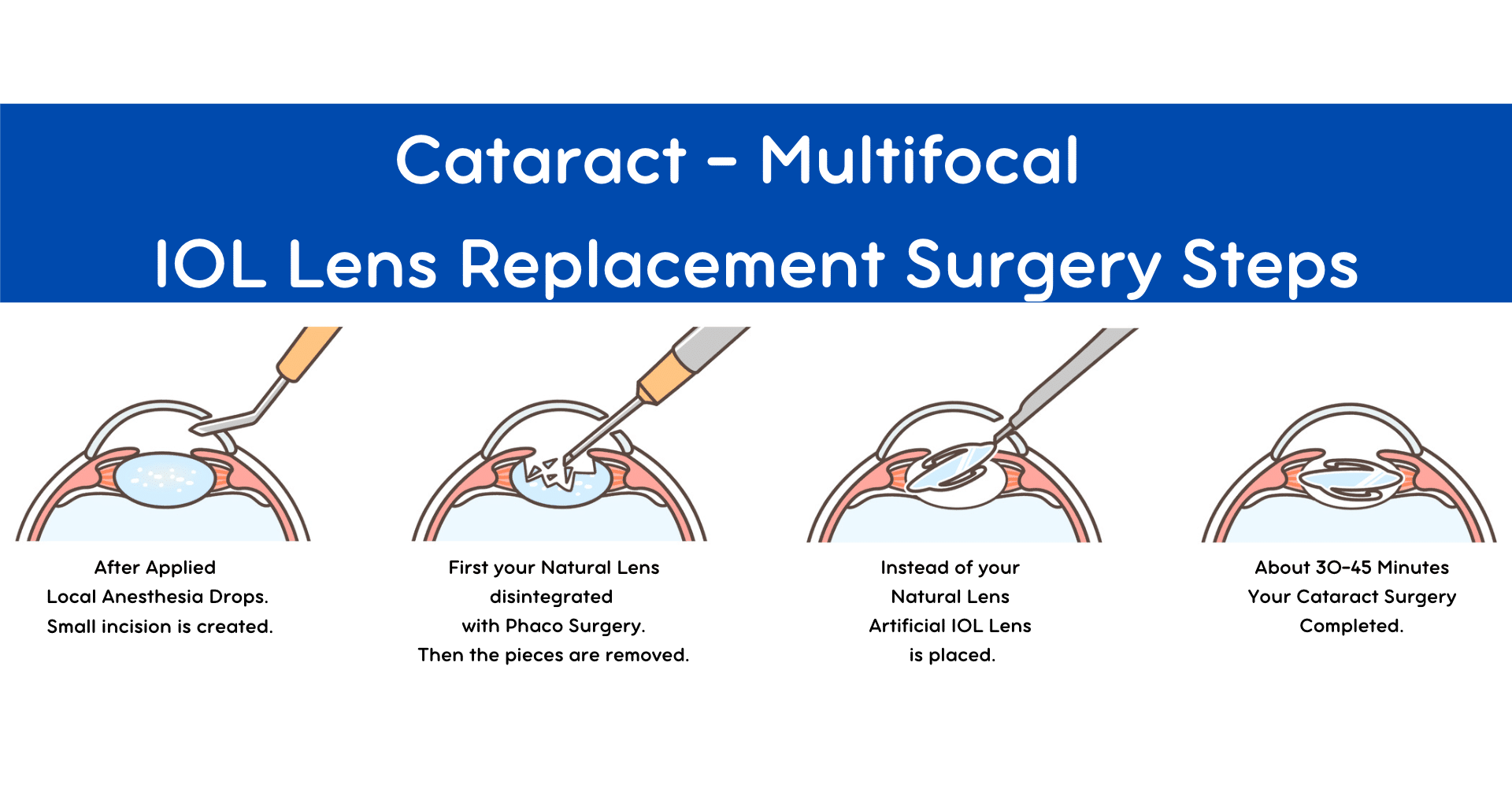 cataract surgery