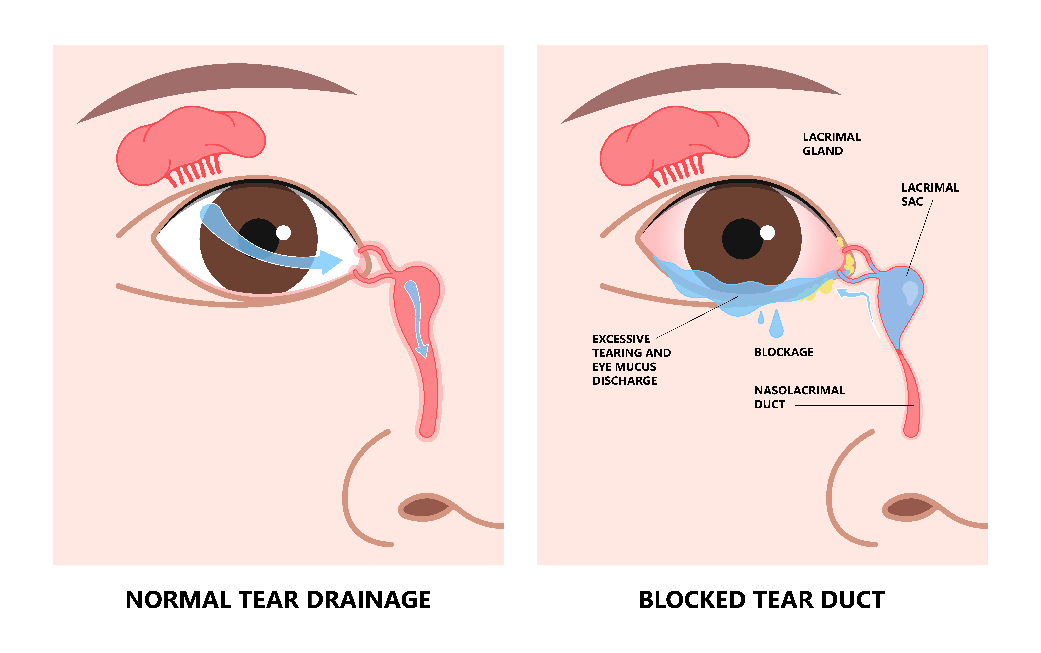 Blocked Tear Duct Surgery