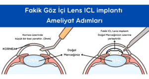 Fakik Göz İçi Lens, Fakik Göz İçi Lens ameliyatı, Fakik Göz İçi mercek, Fakik Göz İçi mercek ameliyatı, Fakik Göz İçi Lens ameliyatları, Fakik, Göz İçi Lens, Lens, Yüksek numaralı hastalar için göz kusuru düzeltme ameliyatı, Yüksek miyop, Yüksek Astigmat, Yüksek hipermetrop, Phakic ICL Lens, intraocular lens implant