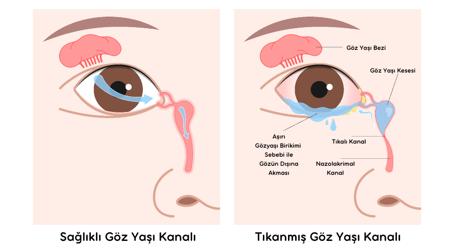 Göz Yaşı Kanal Tıkanıklığı, Göz Yaşı Kanal Tedavisi, DSR Ameliyatı, Göz Yaşı Kanalı, Göz Yaşı, Dacryocystorhinostomy, DSR Tedavisi