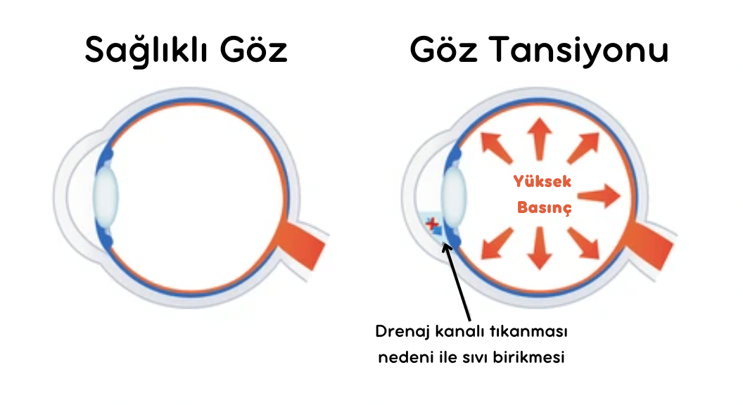 Glokom, Glaucoma, Göz Tansiyonu tedavisi, Göz tansiyonu hastalığı, Göz Tansiyonu ameliyatı, Glokom Ameliyatı, Glokom tedavisi, Glaucoma Hastalığı, glaucoma tedavisi