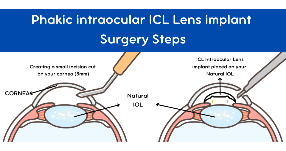Jet Overblijvend Telemacos Phakic Intraocular ICL Lens Surgery - Akıllı Lazer Göz Merkezi
