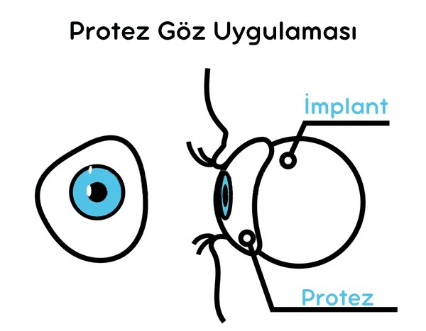 Protez Göz Ameliyatı, Protez Göz, Evisceration, enucleation, enükleasyon, Evisceration, Evisserasyon, enükleasyon ameliyatı, Evisserasyon Ameliyatı