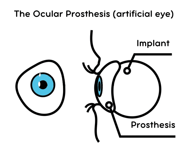 Evisceration, Enucleation, Prosthetic Eye Surgery