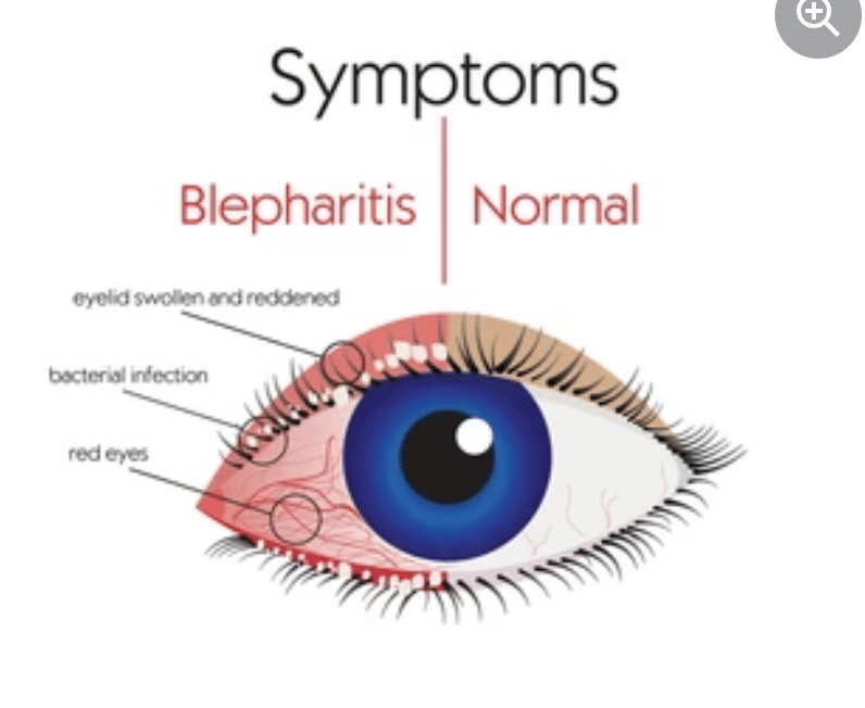 Blepharitis Treatment