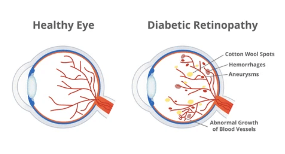 Diabetic Retinopathy Disease