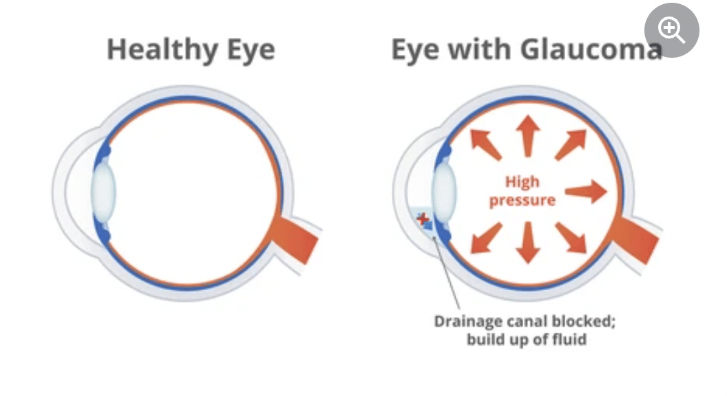 Glaucoma eye disease, Glaucoma