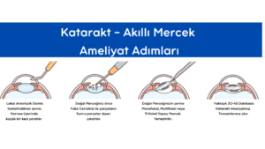 Katarakt Ameliyatı, Katarakt Ameliyatları, Akıllı Lens, Akıllı Mercek, Akıllı Lens Ameliyatı, Akıllı Mercek AMeliyatı, Multifokal, Monofokal, Trifokal, Mercek Ameliyatı, Göz Ameliytaı, Katarakt Göz Ameliyatı, Fako Cerrahisi 