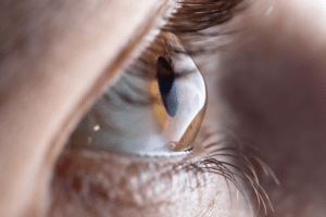 Keratoconus tedavileri, Cross-Linking, Cross-Linking Ameliyatı, Keratokonus tedavileri, Göz İçi Fakik ICL Lens ameliyatı, Katarakt Ameliyatı, Çapraz bağlama Ameliyatı