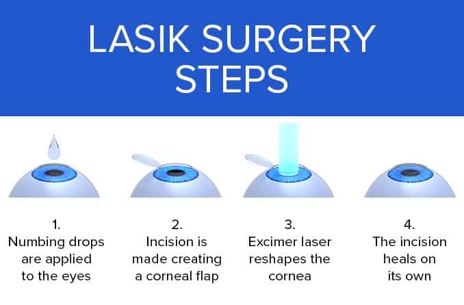 Presbyopia LASIK Smart Laser Surgery Steps