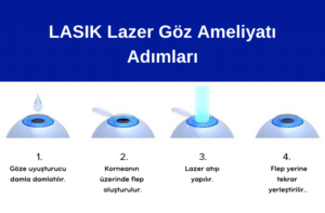 LASIK Lazer göz ameliyatı, LASIK, Lazer, Laser, Göz Ameliyatı, Göz Çizdirme, Göz Çizdirme Ameliyatı, Lazer ile göz çizdirme ameliyatları, Lazer Göz Ameliyatı Adımları, LASIK Lazer göz ameliyatı nasıl yapılır, LASIK Lazer göz ameliyatları hakkında, Uzak, Yakın, Astigmat, Hipermetrop, Mitop, Presbiyopi