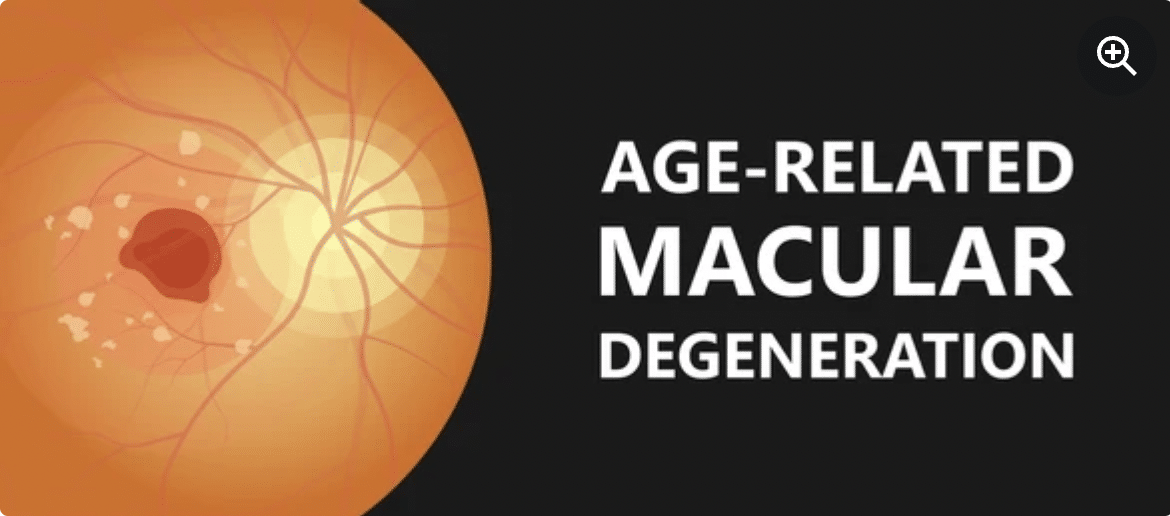 Macular Degeneration Treatment