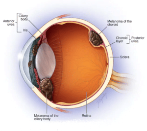 Eye Cancer, Eye Uveal Melanoma, Eye tumor