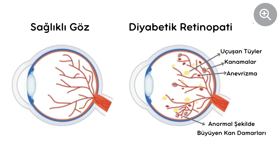 Diyabetik Retinopati, Şekere Bağlı Retinopati, Retinopati, Diabetic Retinopathy