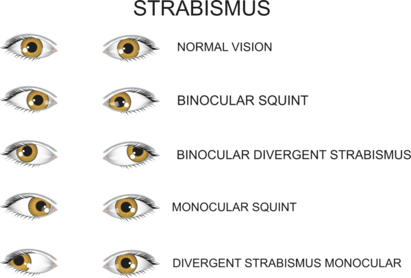 squint, crossed eye, cross eyed, strabismus