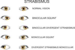 strabismus, Şaşılık türleri, Şaşılık