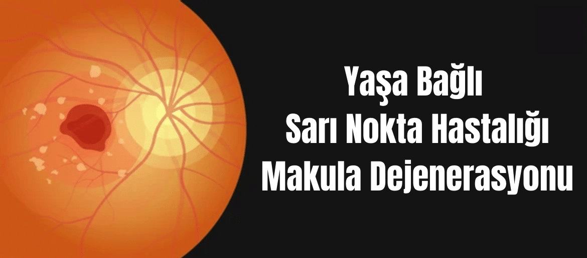 Yaşa Bağlı Makula Dejenerasyonu, Makula Dejenerasyonu, Sarı Nokta Hastalığı, Sarı Nokta, Macular Degeneration