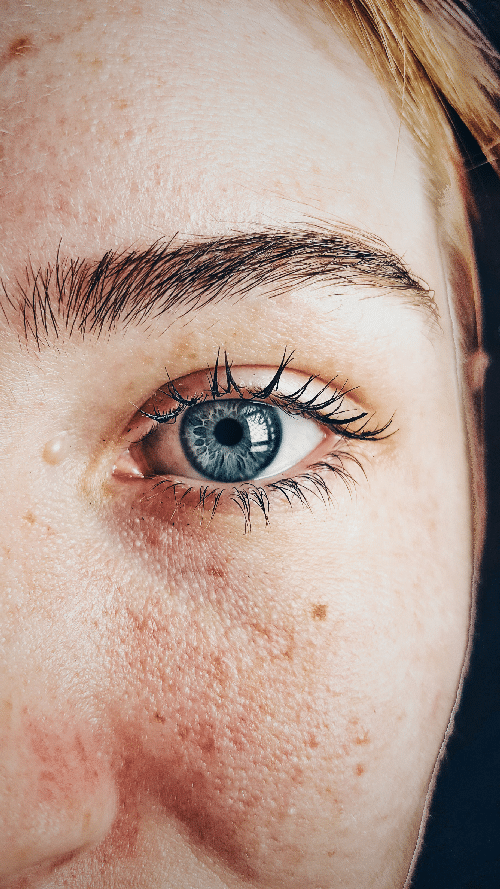 Göz Kuruluğu, Dry Eye Syndrome, Kuru Göz, Göz Kuruluğu Hastalığı