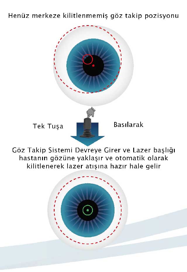 Lazer ameliyatı teknolojisi, eye tracker