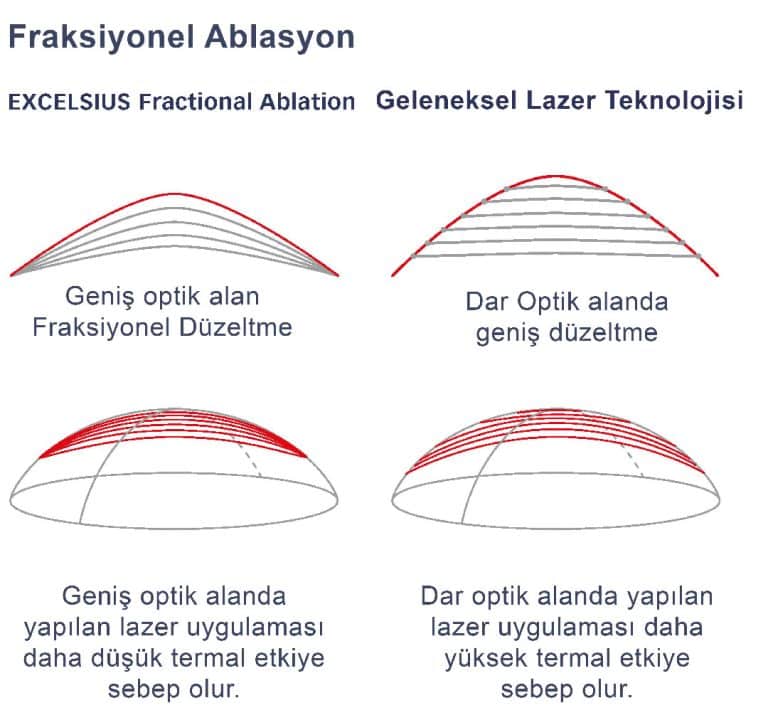 Lazer ameliyatı teknolojisi