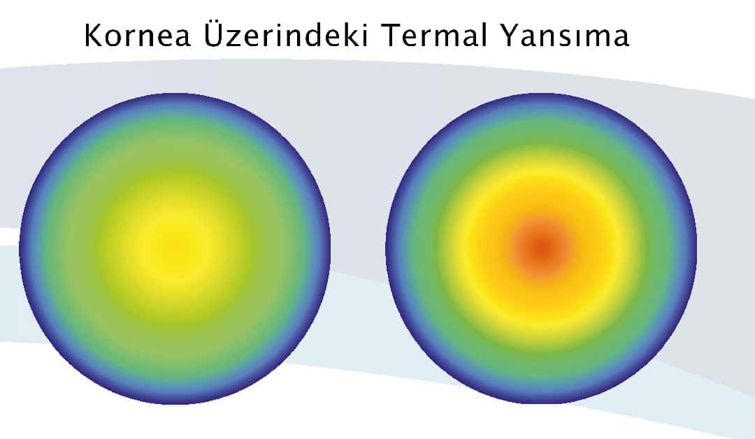 Lazer ameliyatı teknolojisi