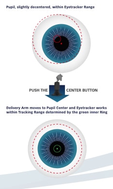 Lazer Göz uygulama tekniği, Eye tracker, göz takip sistemi