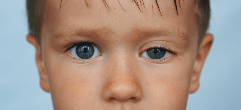 Pitoz, Çocuklarda Göz Kapağı Düşüklüğü Ameliyatı öncesi, Göz Kapağı Estetiği