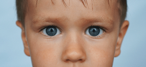 Çocuklarda Göz Kapağı Düşüklüğü sonrası, pitosiz, Göz Kapağı Estetiği