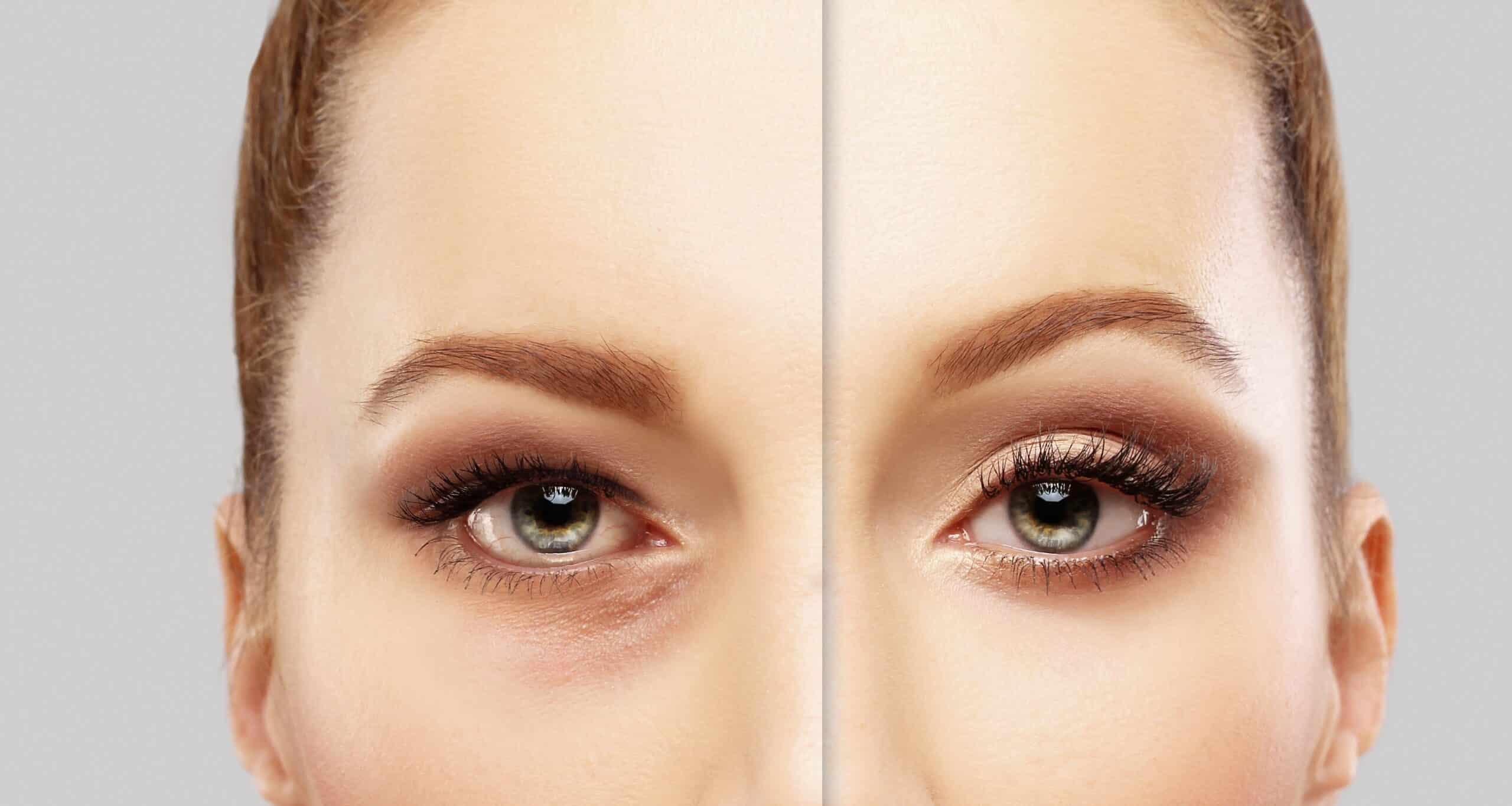 Badem Göz Ameliyatı, Göz Kapağı Estetiği