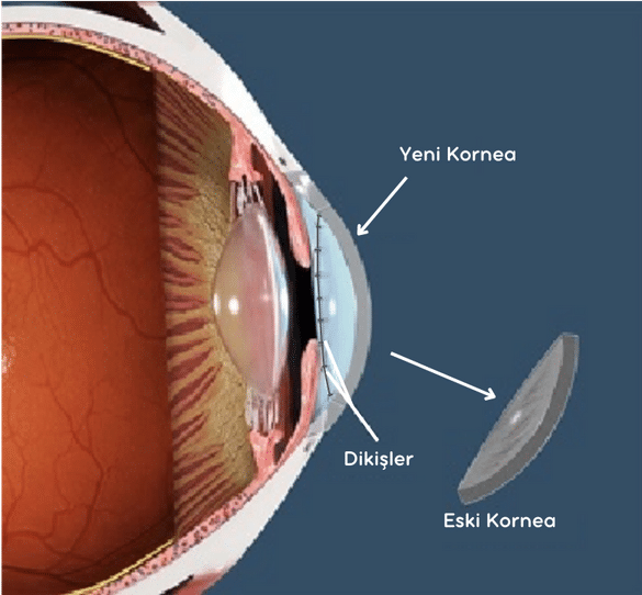 Kornea Nakli, Keratoplasti, Kornea Nakli Ameliyatı, Kreatoplasti Ameliyatı, Cornea Transplant, Keratoplaty Surgery,