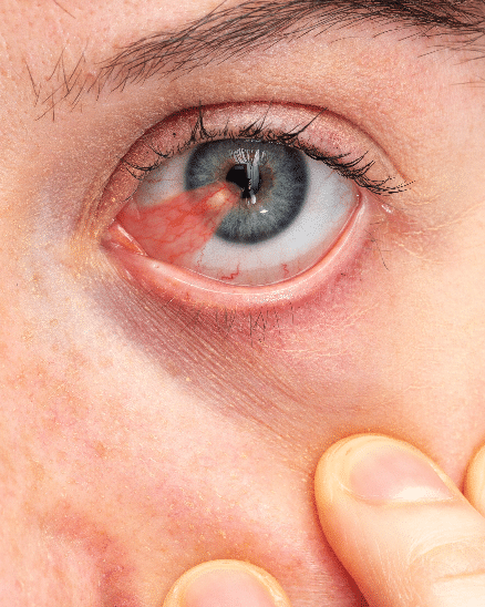 Pterygium surgery