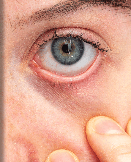 Pterygium surgery